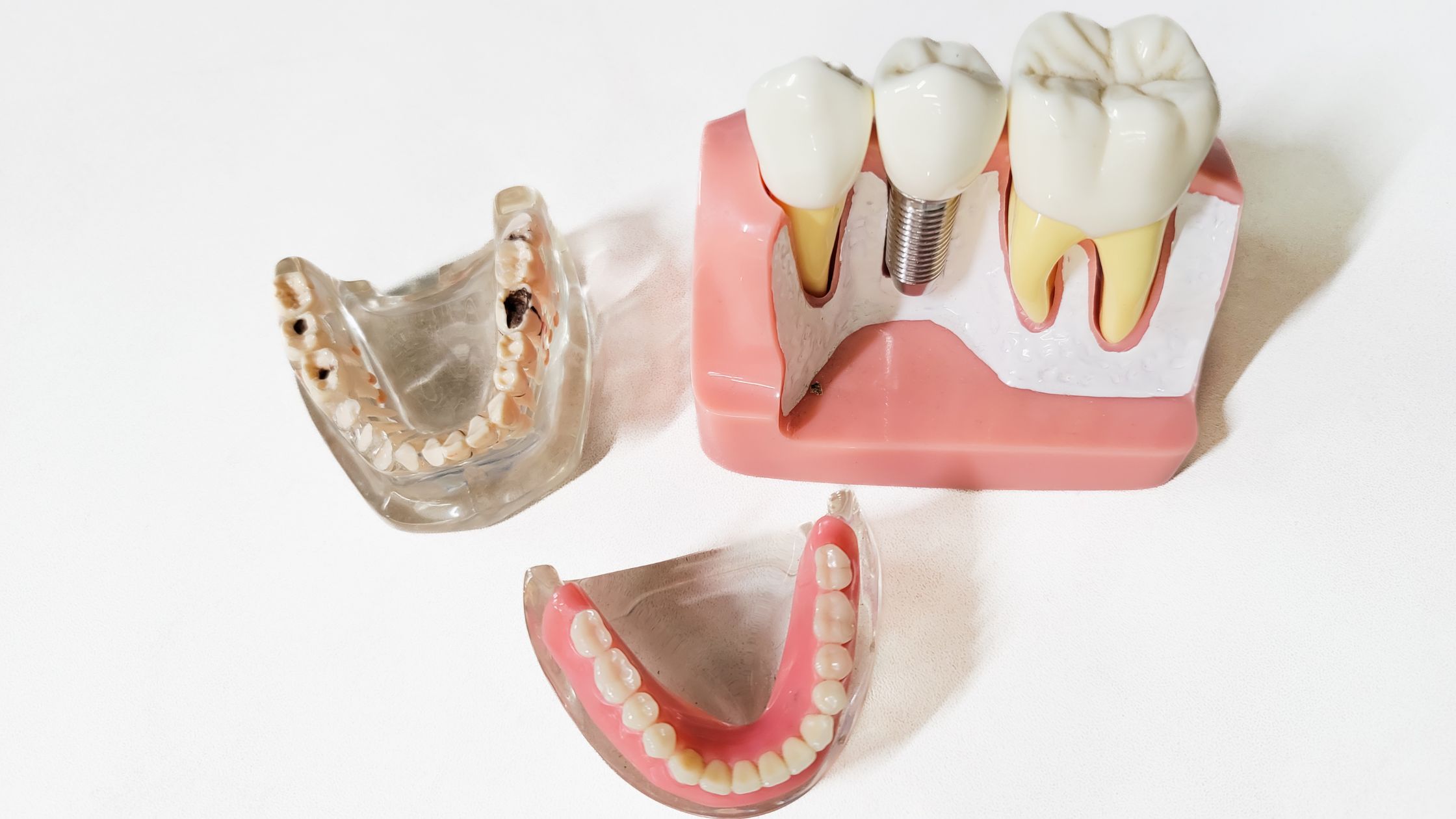 Dental Implants Vs. Dentures Making The Best Choice For Your Smile (Charlotte, NC)