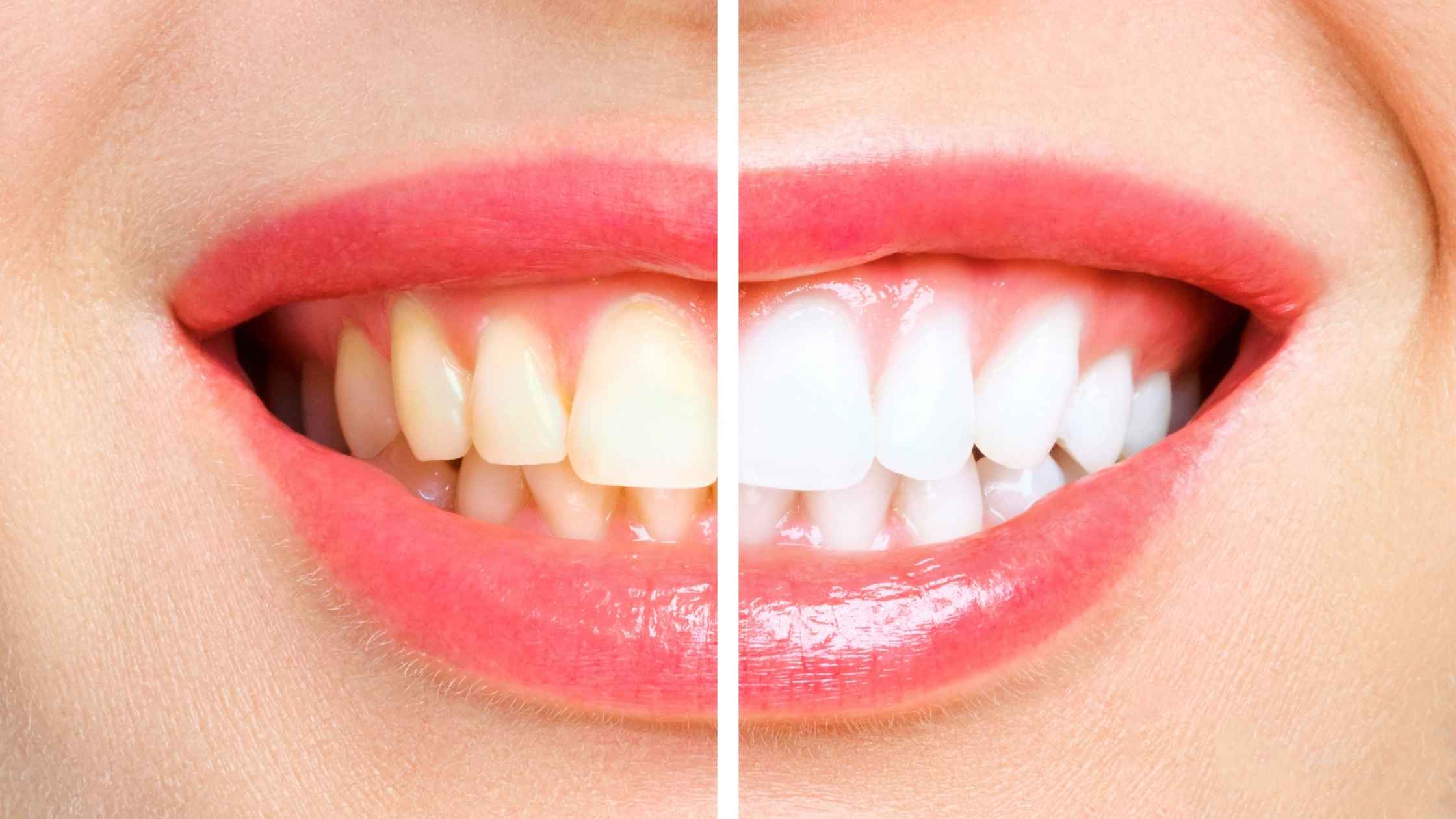 Teeth Whitening Charlotte NC