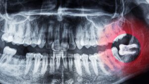 Painless Wisdom Tooth Extraction: Charlotte, NC