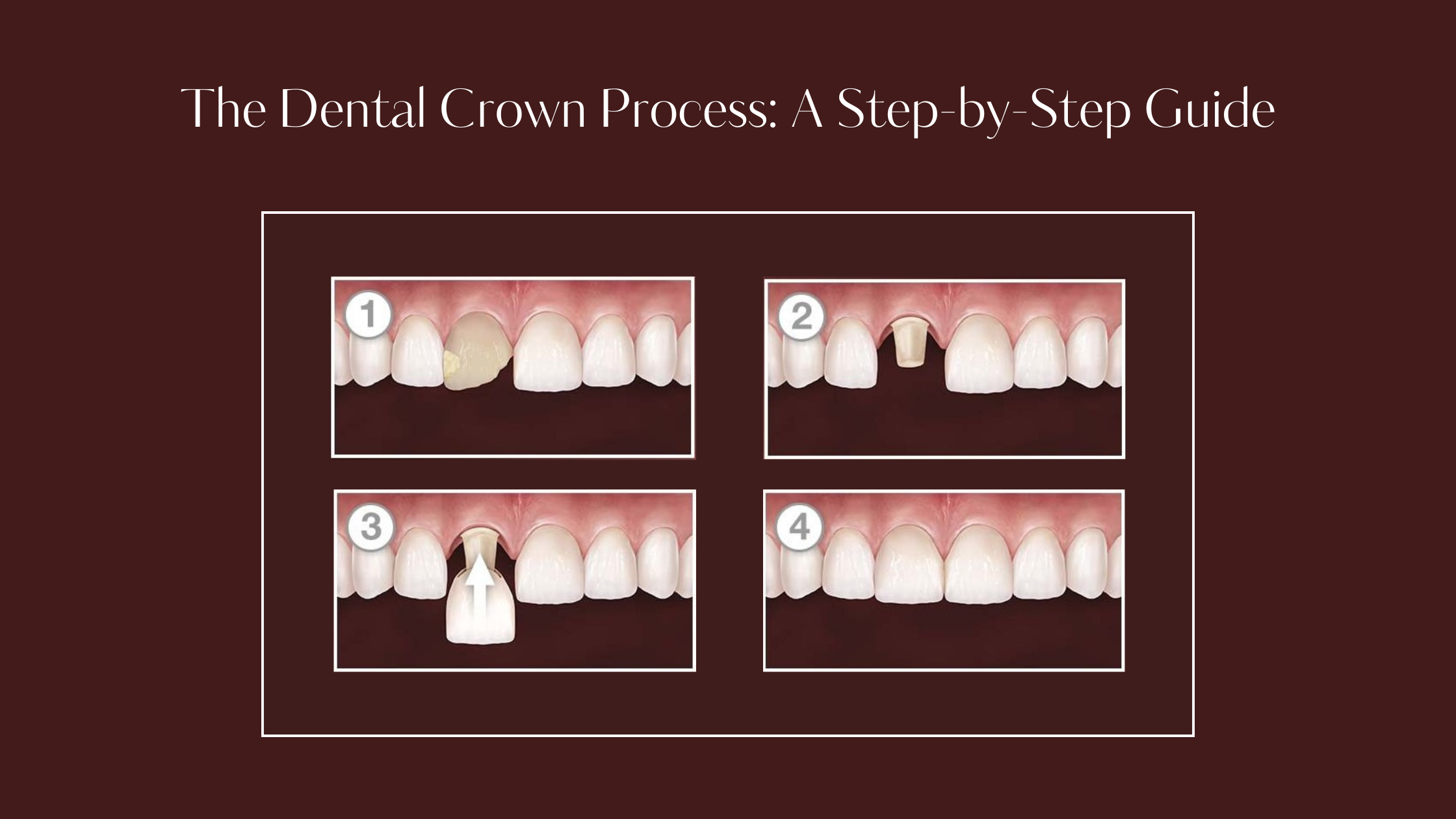 The Dental Crown Process A Step-by-Step Guide